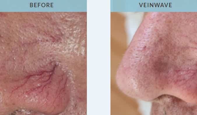 thread vein removal