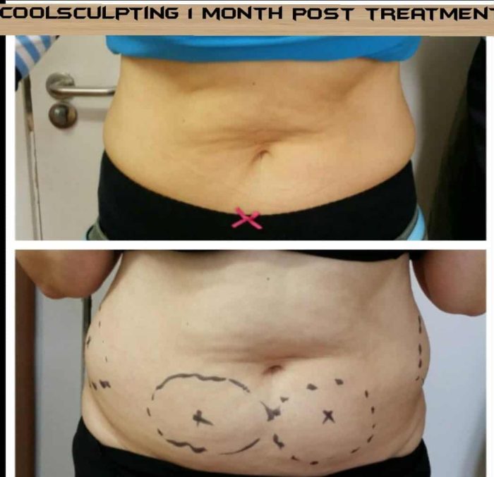 stomache fat freezing