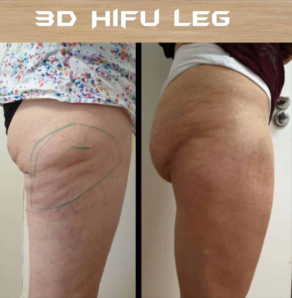 CoolSculpting for Saddlebags