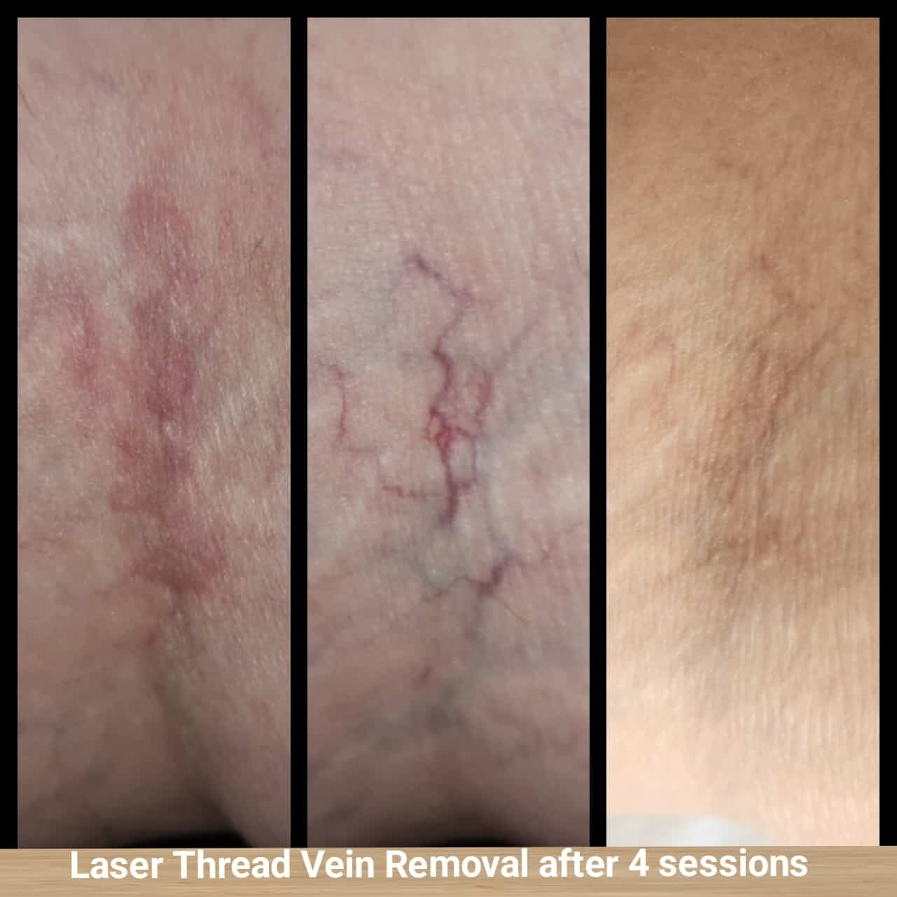 laser thread vein removal