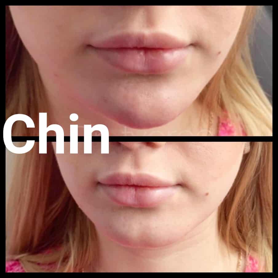 Chin Filler