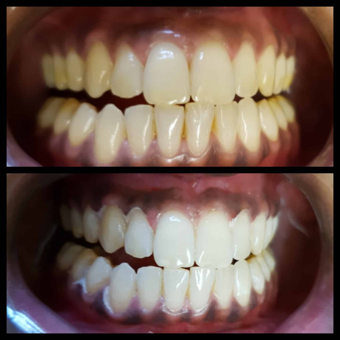 Laser Teeth Whitening London