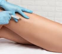 Microsclerotherapy-Leg Thread Vein & Spider Veins Removal