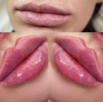 lip filler