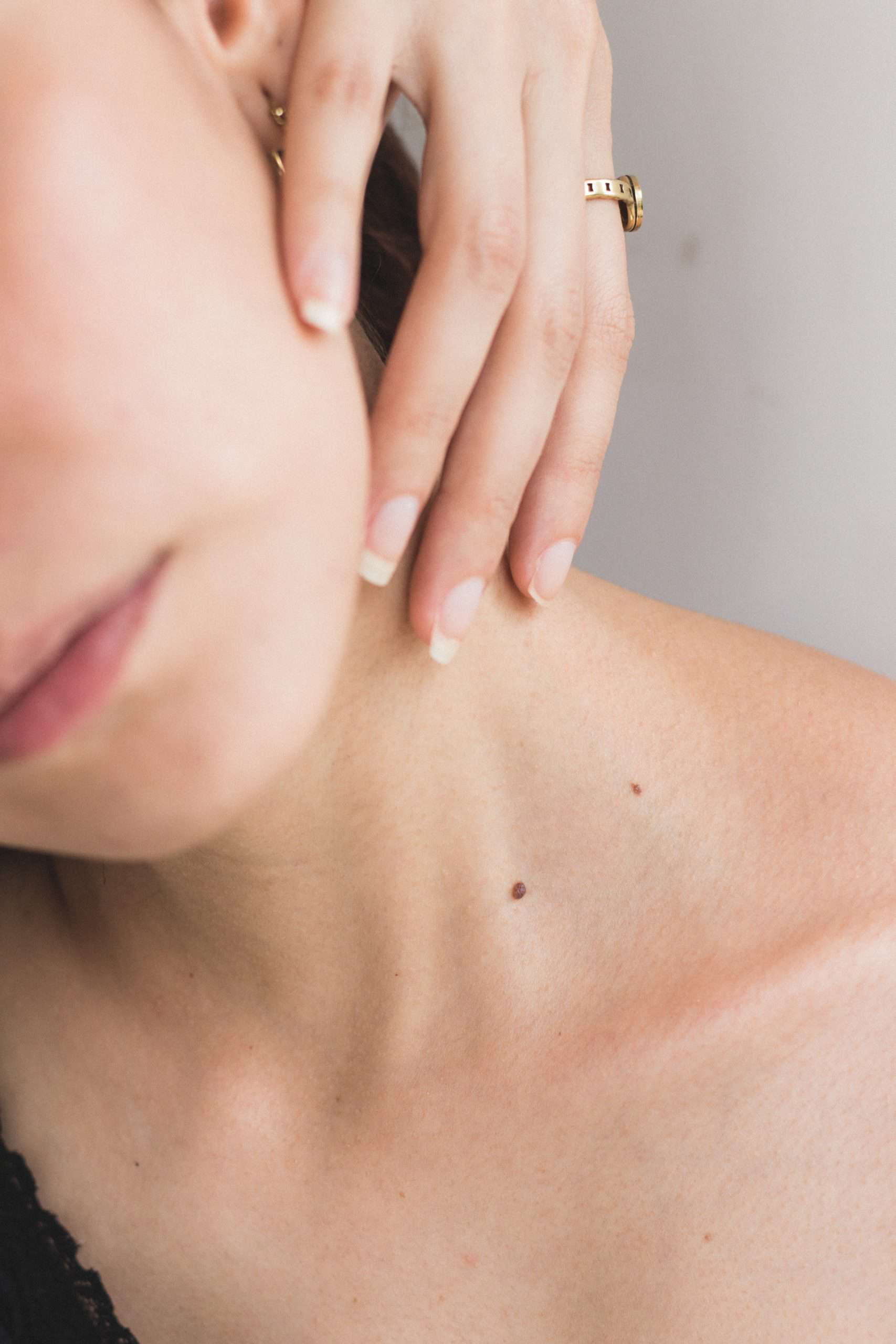 skin tags 2