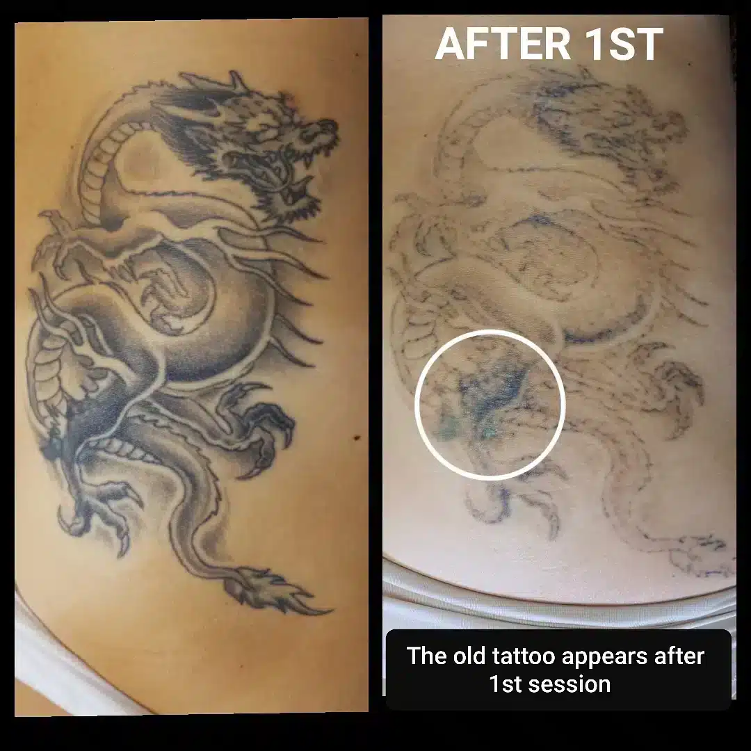 tattoo-removal