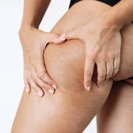 Cellulite Treatment 2