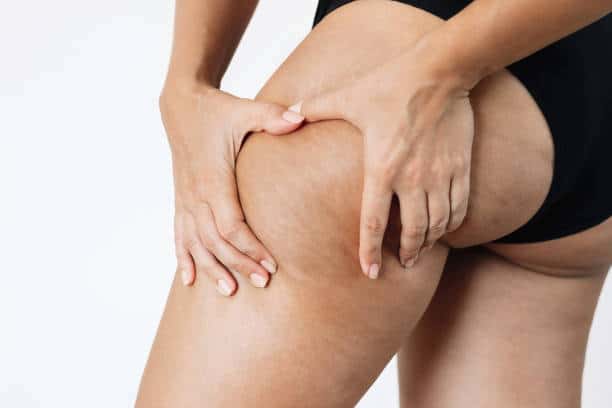 Cellulite Treatment 2