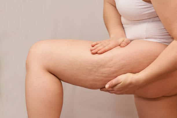 cellulite treatment centers