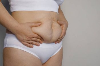 Cellulite Treatment 3