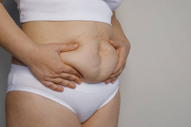 Cellulite Treatment 3