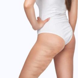 Cellulite Treatment 8