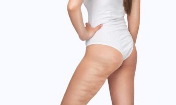Cellulite Treatment 8
