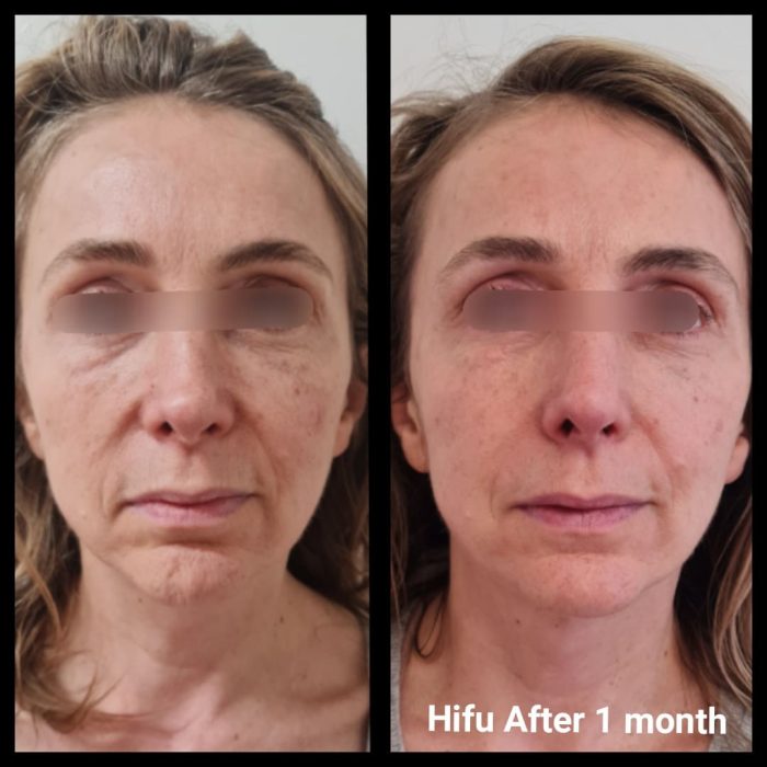 before and after hifu