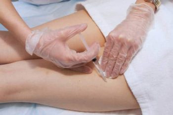 Sclerotherapy