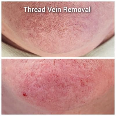 thread vein removal before and after