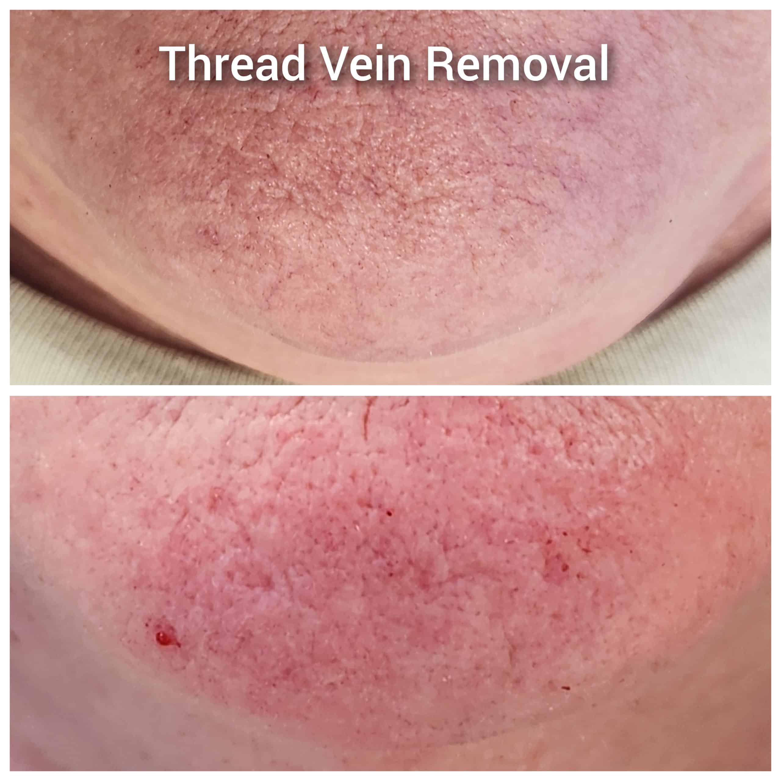 thread vein removal before and after
