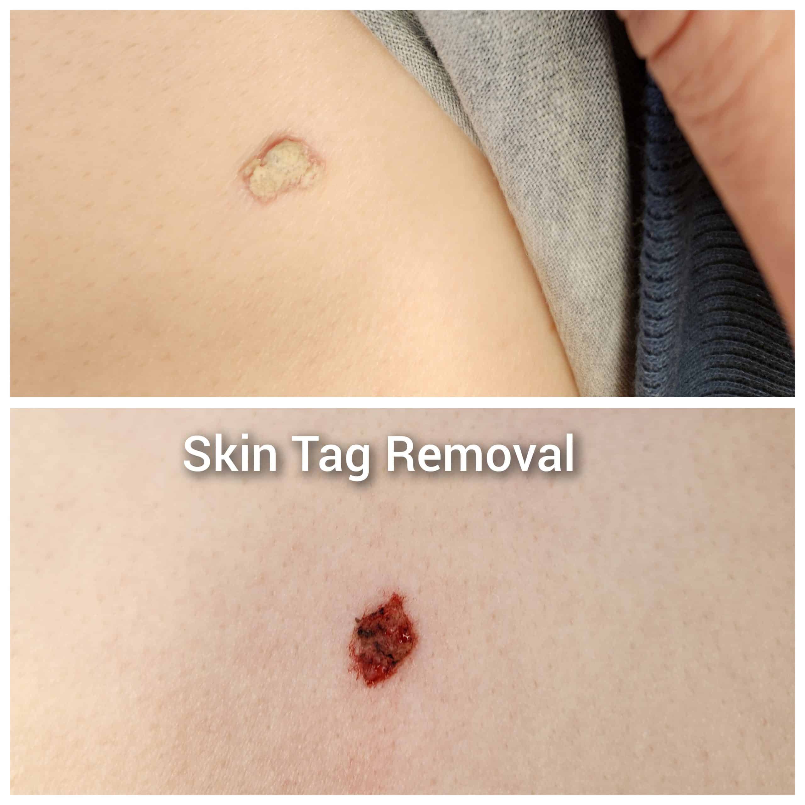 skin tags before and after