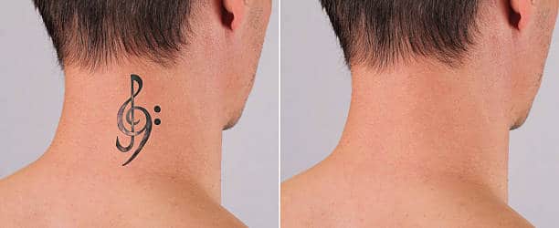 Laser tattoo removal before and after