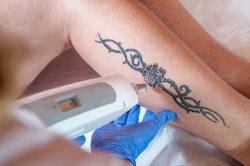 laser-tattoo-removal