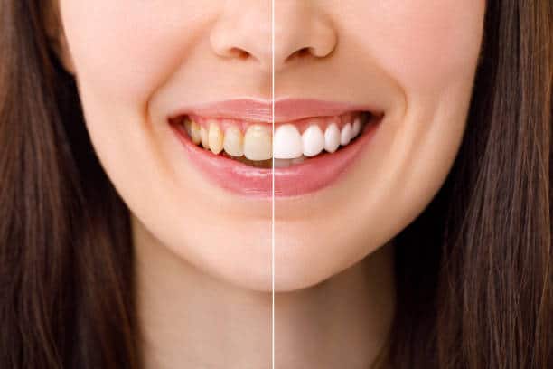 laser teeth whitening
