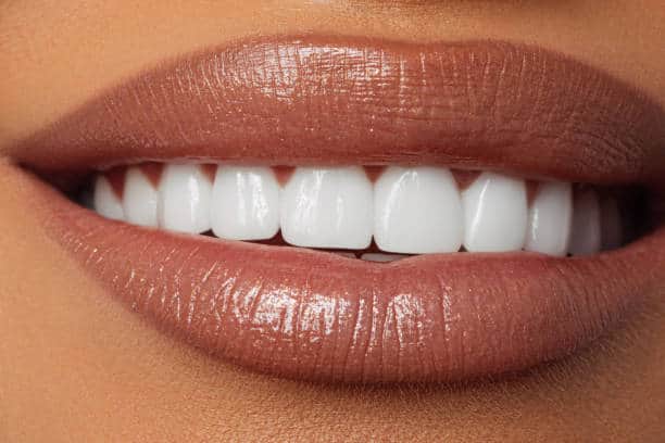 laser-teeth-whitening
