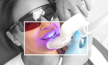 laser teeth whitening 37