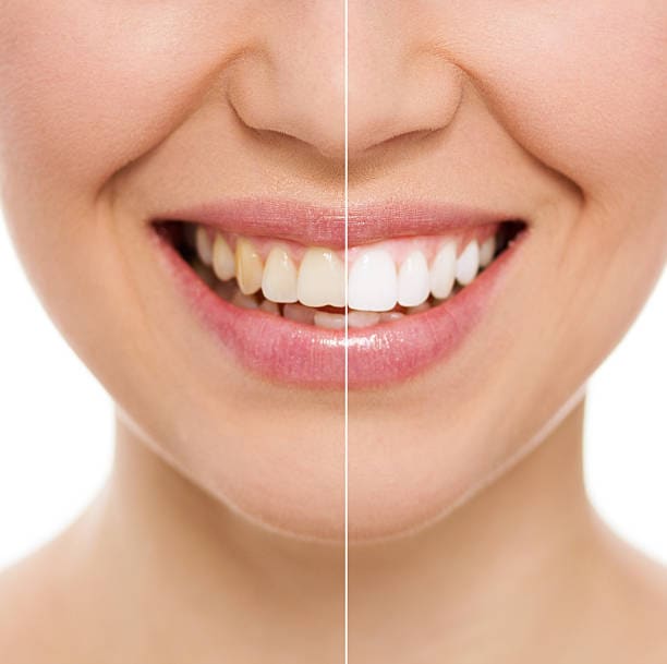 laser teeth whitening