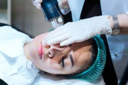 microneedling