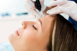 microneedling