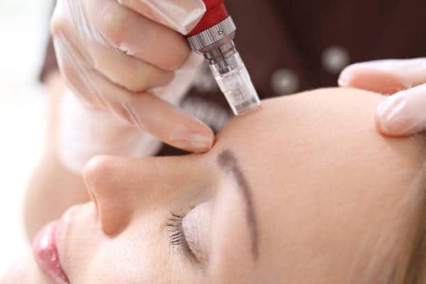 microneedling13