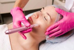 microneedling