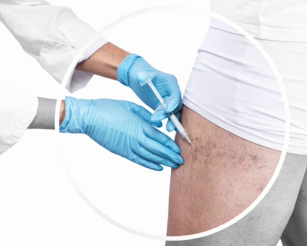 sclerotherapy 2 1