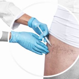 sclerotherapy 2 1