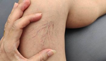 spider vein removal 3