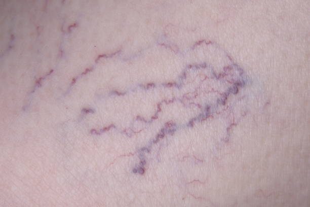 spider veins removal