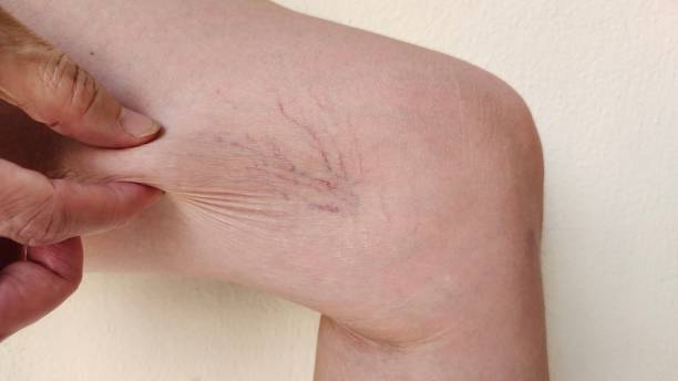 Spider Veins Removal