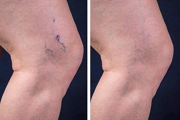 Spider Veins Removal Before and After