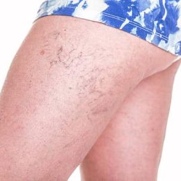 spider veins removal 5