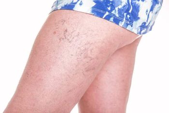 spider veins removal 5