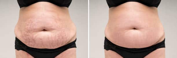 stretch marks removal