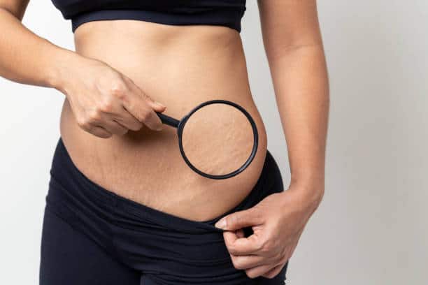 stretch marks removal