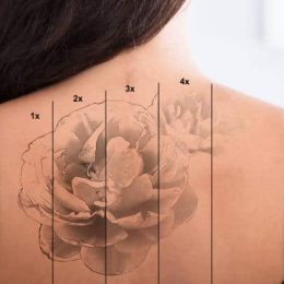 tattoo removal 6 1