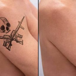tattoo removal before and after