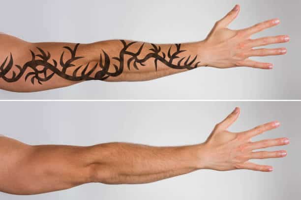 tattoo removal before and after 3