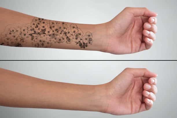 Tattoo Removal Treatment Before and After