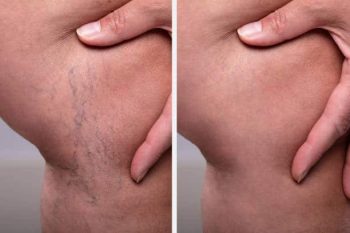 thread vein removal 5