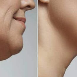 double chin 14