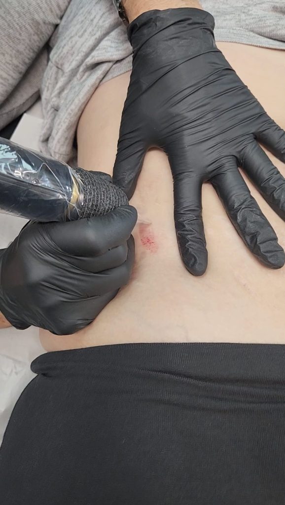 stretch marks removal 22 e1721266610253