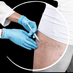 MICROSCLEROTHERAPY